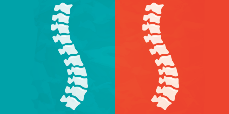 I Have Scoliosis And Here’s What I Want You To Know